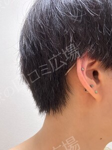 治療直後の症例写真