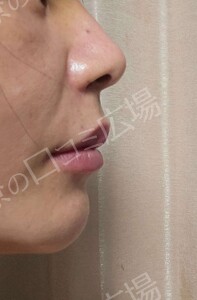 治療直後の症例写真