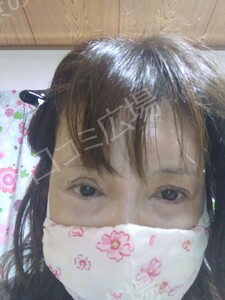 治療直後の症例写真