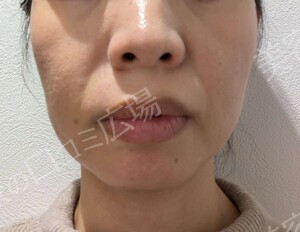 医療ハイフ｜頬・フェイスラインのたるみの治療直後の症例写真