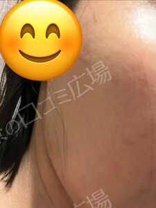 治療直後の症例写真