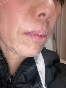 治療直後の症例写真
