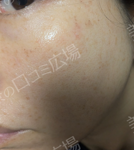 治療直後の症例写真