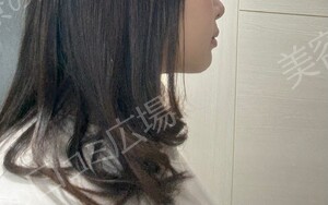 治療直後の症例写真