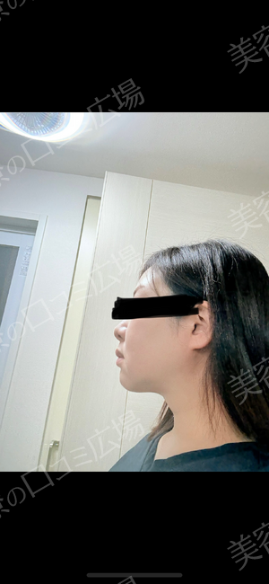エバーグリーンメディカルクリニックのHIFU・照射系リフトアップ治療の症例写真[ビフォー]