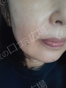 治療直後の症例写真