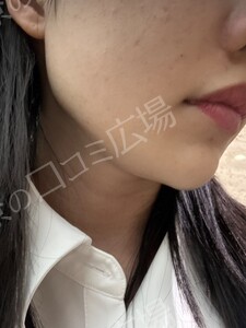 治療直後の症例写真