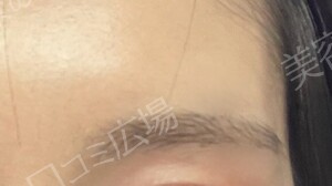 【口コミ広場期間限定価格】韓国製ボトックス｜1部位の治療結果の症例写真