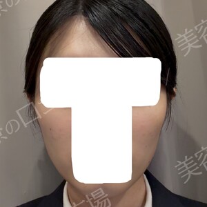 ギャラリークリニックのリフトアップの症例写真[ビフォー]