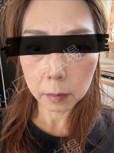 治療結果の症例写真