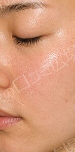 治療直後の症例写真