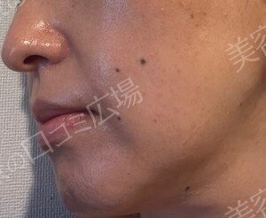 治療結果の症例写真