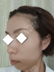 治療前の症例写真