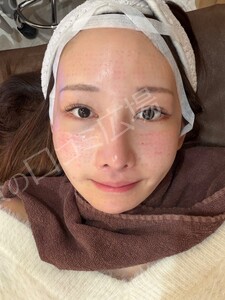 治療直後の症例写真