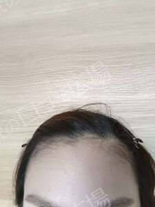 治療結果の症例写真