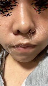 治療直後の症例写真