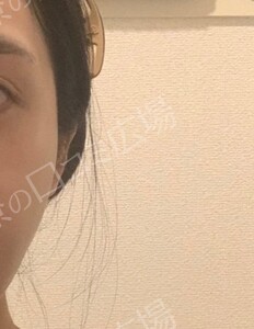 治療直後の症例写真