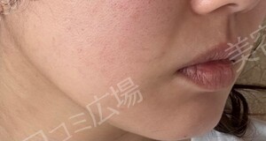 治療直後の症例写真