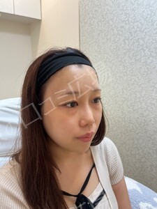 【筒井院長】脱脂術＋ピュアグラフティング　リポキューブの治療前の症例写真