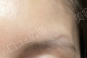 【口コミ広場期間限定価格】韓国製ボトックス｜1部位の治療直後の症例写真