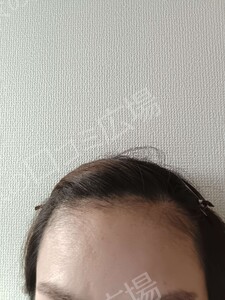 治療結果の症例写真