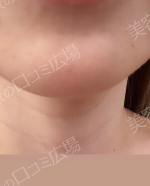 ルラ（LULA）美容クリニック 岡山院の輪郭・顎・エラ・額・小顔整形の症例写真[ビフォー]