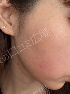 イオン導入｟リピーターOK｠の治療結果の症例写真