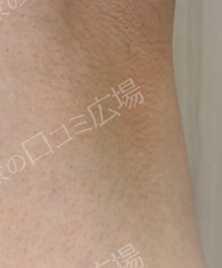 治療結果の症例写真
