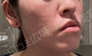 治療直後の症例写真