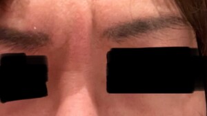 ジョウクリニックのしわ・たるみ整形(注入、糸、フェイスリフト)の症例写真[ビフォー]