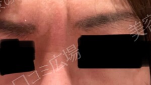 ジョウクリニックのリフトアップの症例写真[ビフォー]