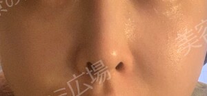 ジェネシスの治療前の症例写真