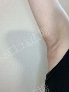 治療直後の症例写真