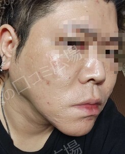 治療直後の症例写真