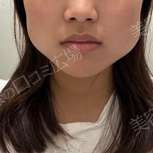 治療直後の症例写真