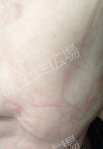 治療直後の症例写真