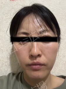 治療直後の症例写真