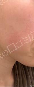 イオン導入｟リピーターOK｠の治療直後の症例写真