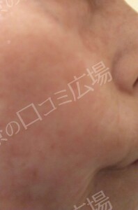 治療直後の症例写真