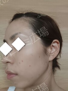 治療直後の症例写真