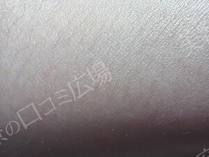 治療前の症例写真