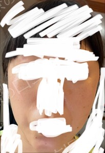 治療前の症例写真
