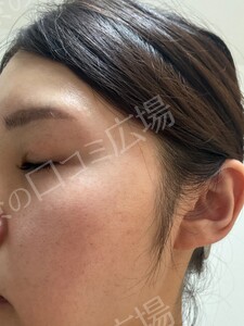 ジェネシスの治療結果の症例写真