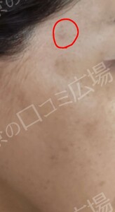 治療直後の症例写真