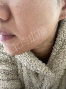 治療直後の症例写真