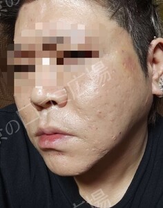 治療直後の症例写真