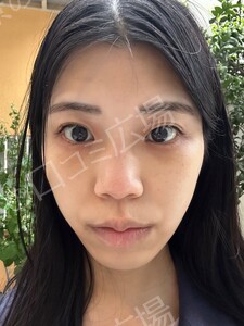 治療直後の症例写真