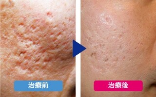 ニキビ 跡 凸凹