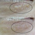 ミニマルクリニック 汗管腫 水疱瘡跡クリニック の口コミ 評判 美容医療の口コミ広場